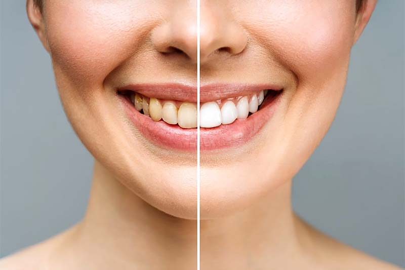 Dientes de una mujer antes y después del blanqueamiento.