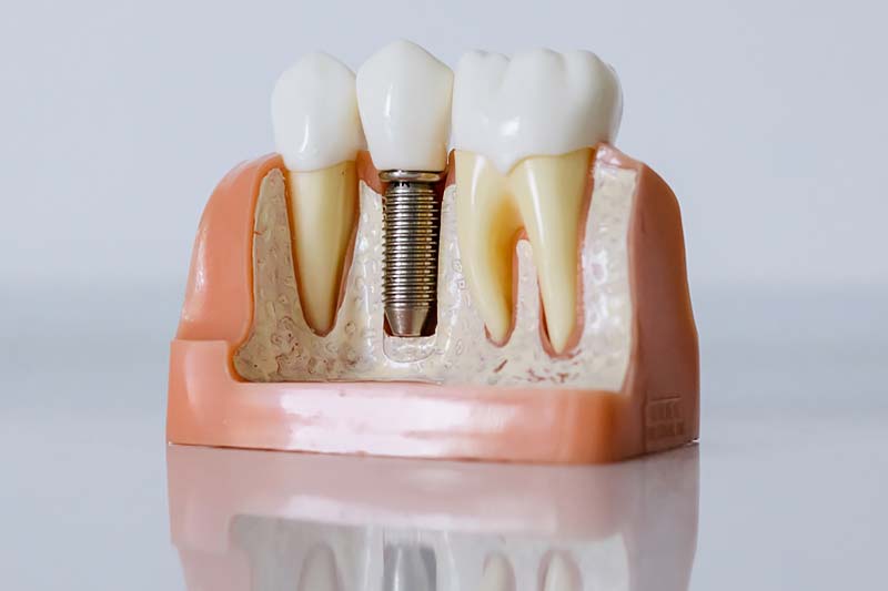 Primer plano del modelo de implante dental.
