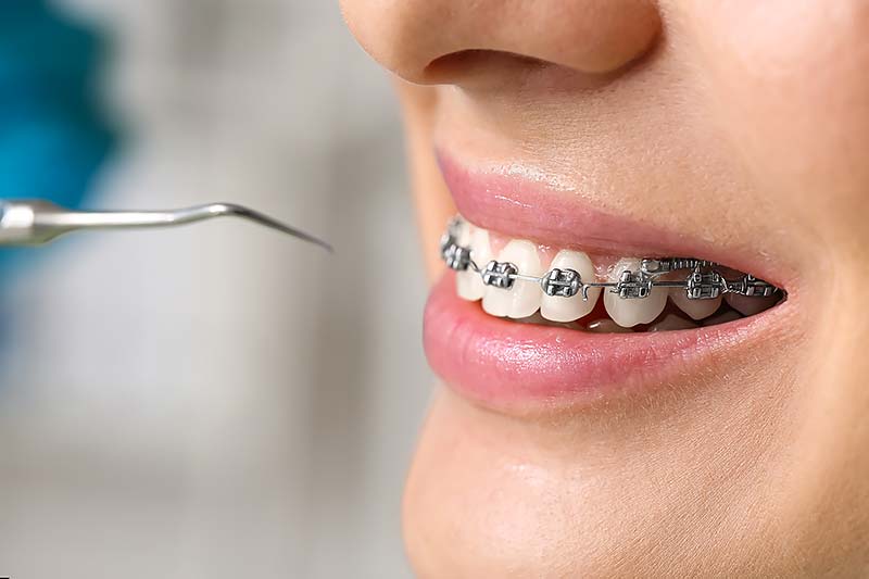 Mujer con aparatos dentales visitando al dentista en la clínica, primer plano.